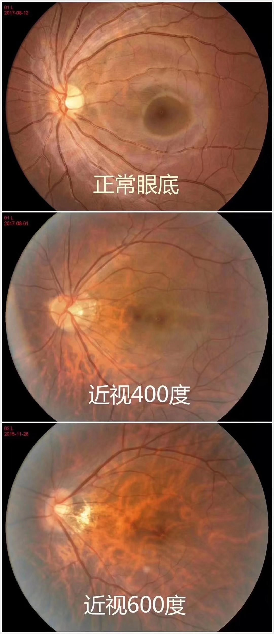 高度近視為什么會這么可怕_易視界