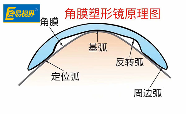 近視以后可否呆角膜塑形鏡【易視界眼健康管理機構】
