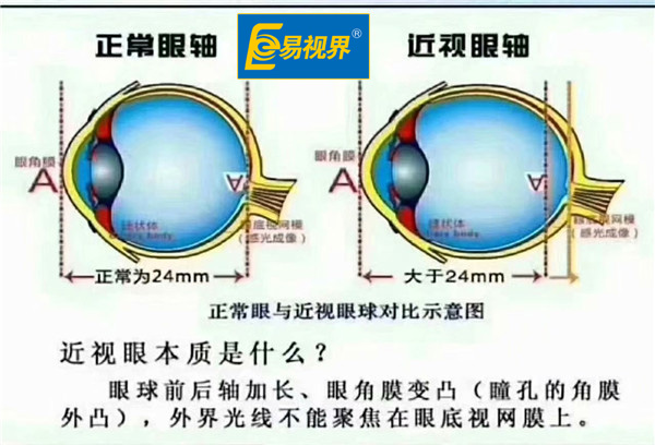 正常眼與近視眼球對比示意圖