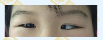 什么是先天性內(nèi)斜視？