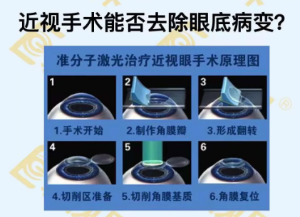 近視手術(shù)能否去除眼底病變？