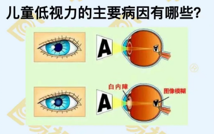 兒童低視力主要病因有哪些？