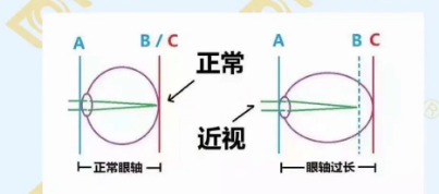 哪個年齡近視度數(shù)最容易增長？