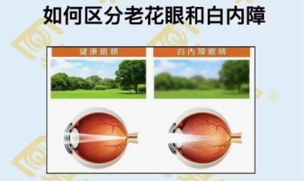 如何區(qū)分老花眼和白內(nèi)障？