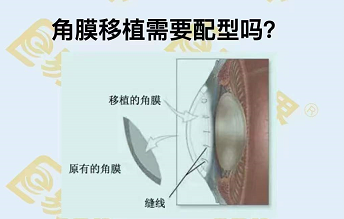 角膜移植需要配型嗎？