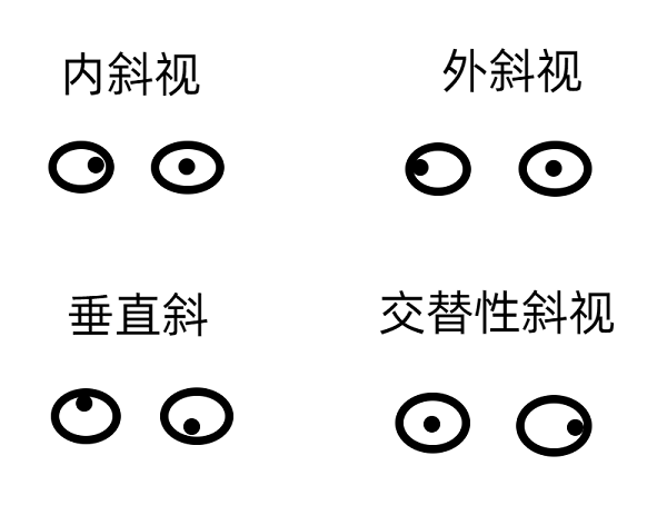 斜視早期的癥狀有哪些？